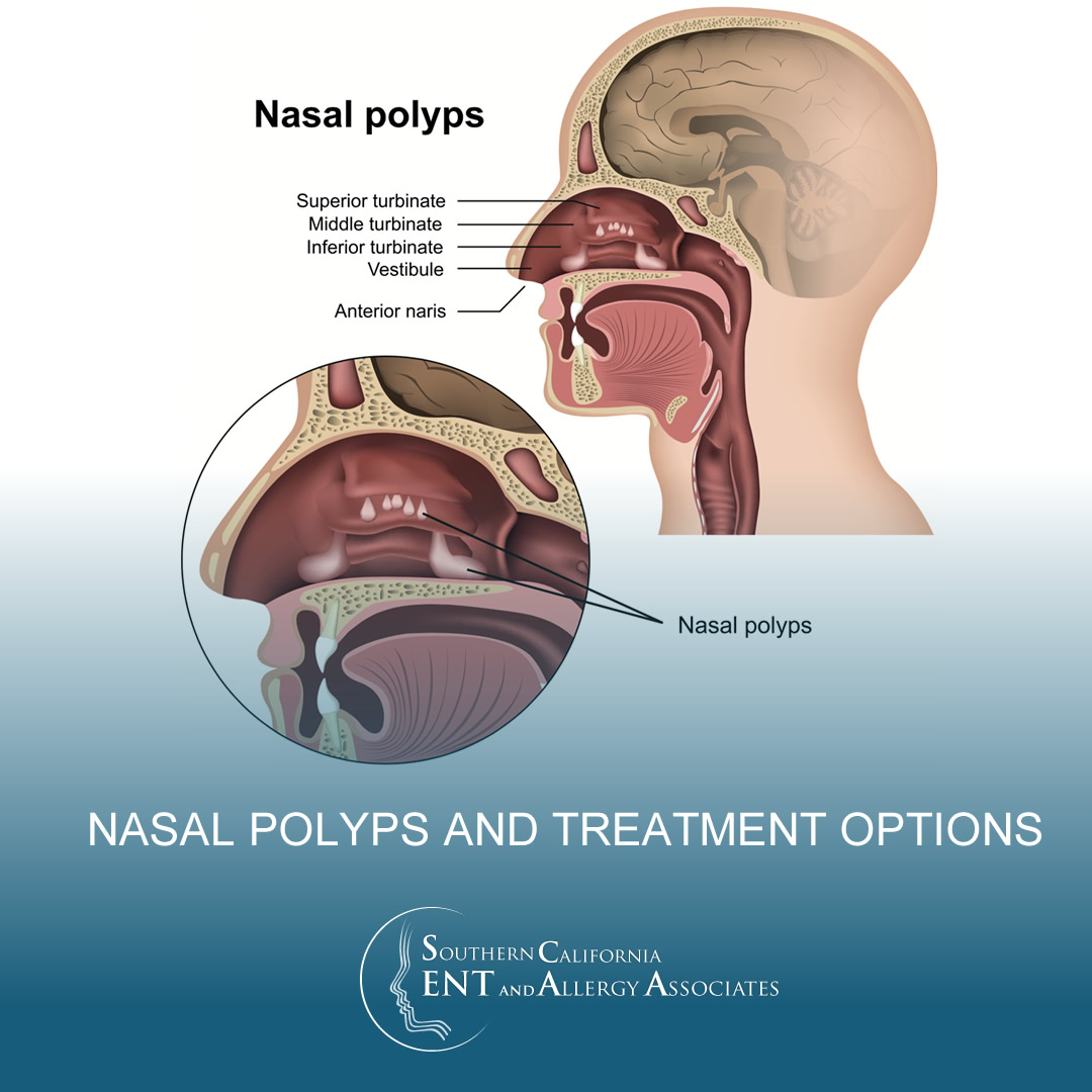Nasal Polyps and treatment options Glendale & Burbank, CA - (SCENTAA)