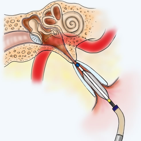 Eustachian Tube Balloon Dilation System Glendale & Burbank, CA Eustachian Tube Balloon Dilation System Glendale & Burbank, CA
