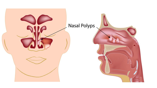 nasal-polyps Nasal Polys Treatment Glendale & Burbank, CA - (SCENTAA)