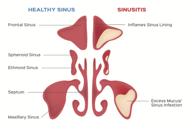Chronic Sinusitis Treatment Glendale & Burbank Chronic Sinusitis Glendale & Burbank