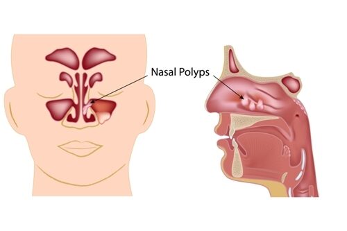 Nasal,Polyps